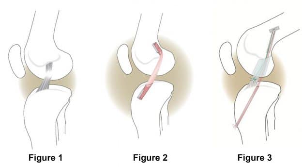 new-acl-surgery-may-improve-the-lives-of-many