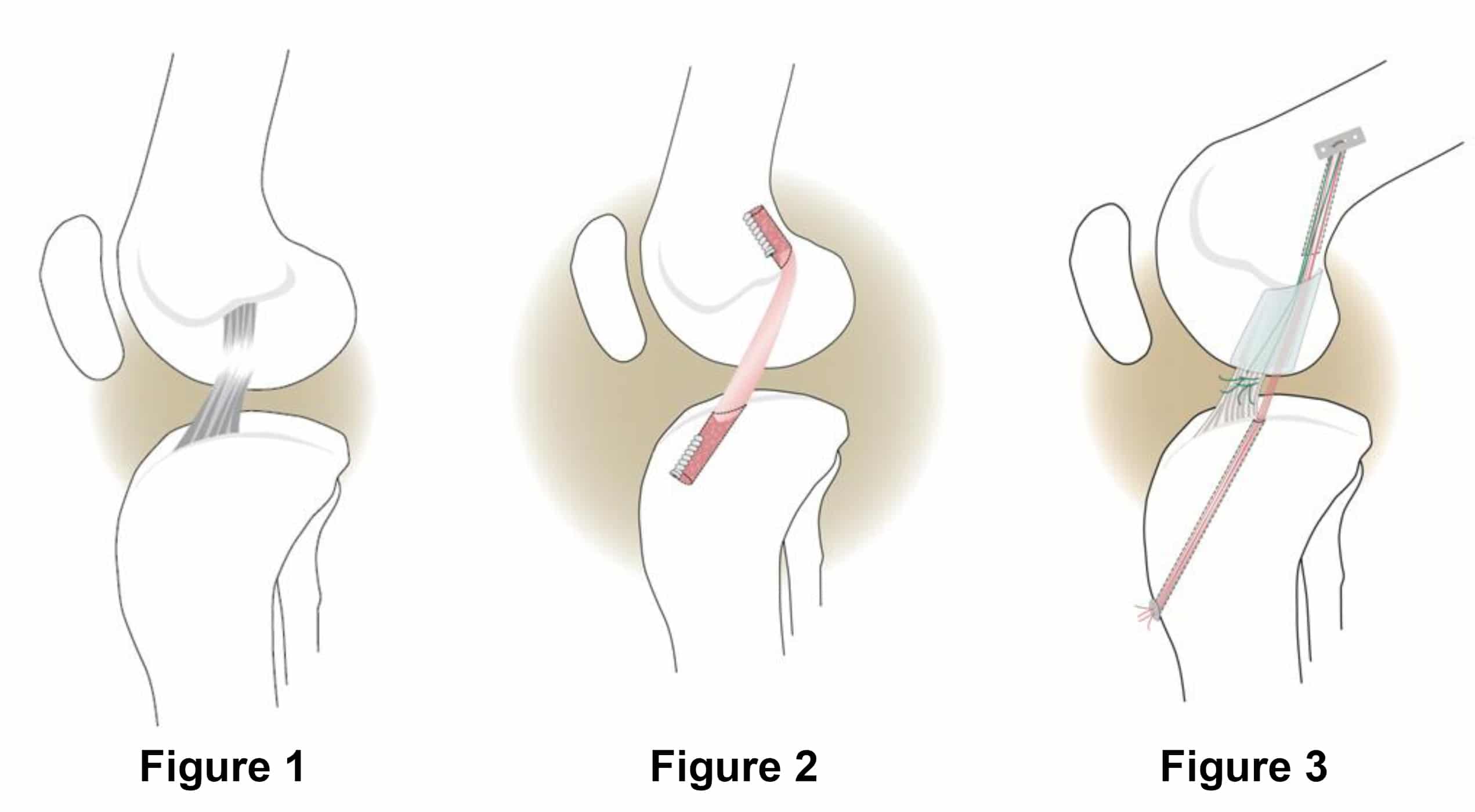 ACL Knee Surgery Picture Blog, May, 2016