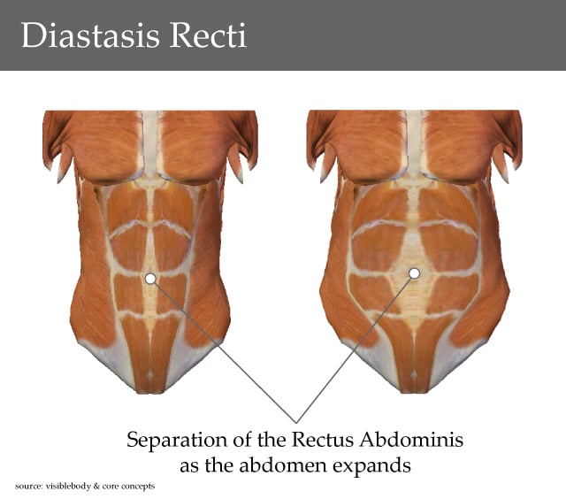 diastasis-recti